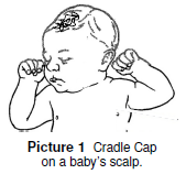 čepice kolébky na pokožce hlavy dítěte's scalp