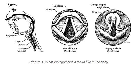 What laryngomalacia looks like in the body