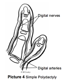 Simple Polydactyly