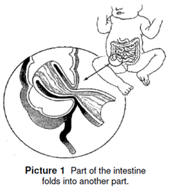 Part of the intestine folds into another part