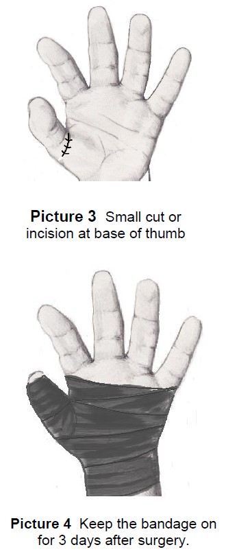 the incision and bandage after surgery 