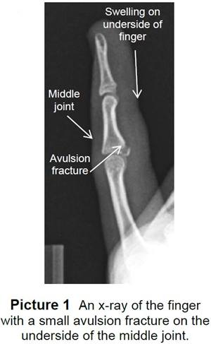 x-ray of a finger