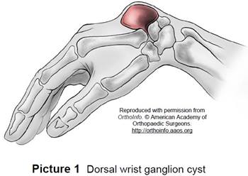Unveiling Ganglion Cyst Complications: When to Seek Medical Attention