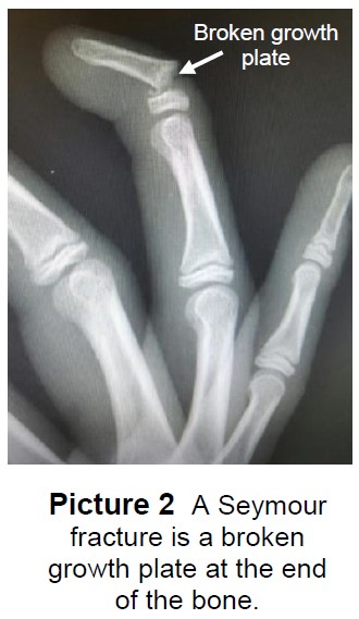 X-ray of a Seymour fracture