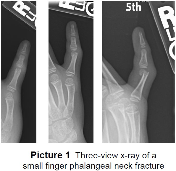 Phalangeal Neck Finger Fracture