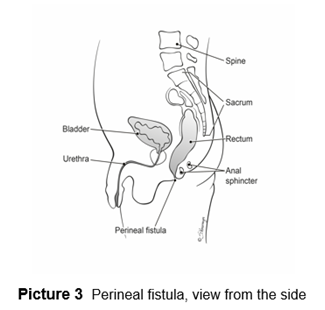 Perineal fistula at birth, view from side