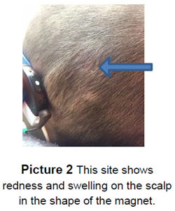 cochlear implant