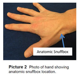 Photo of hand showing anatomic snuffbox location.