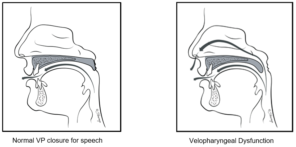 Normal VP closure for speech vs. Velopharyngeal Dysfunction