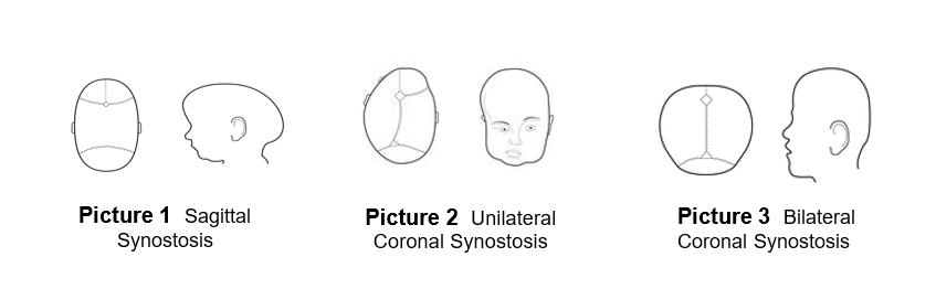 Shows sagittal synostosis, unilateral coronal synostosis and bilateral coronal synostosis