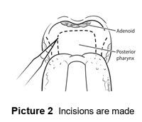 Incisions are made