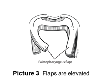Flaps are elevated