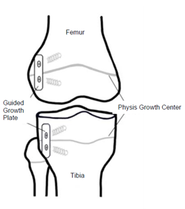 Guided Growth Plate 