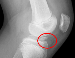 X-ray showing the knee with a red circle around the tibial spine fracture