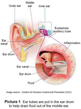 Fluid behind the ear drum in the middle ear