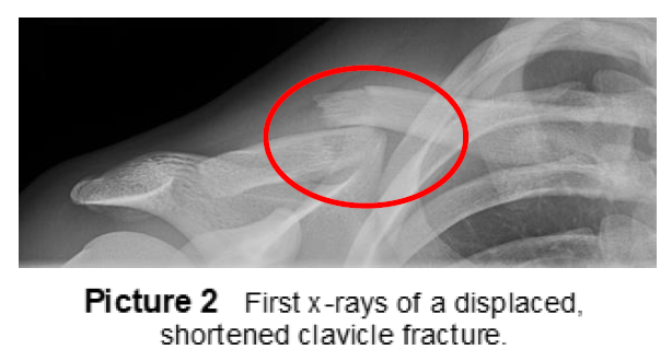 Clavicle Fracture