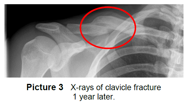 Clavicle Fracture