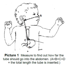 oxygen nose tube placement