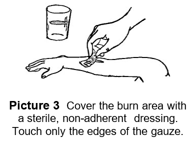 burn dressing