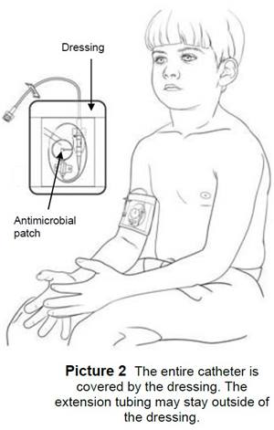 picc line