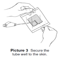 Secure the Tube to the Skin