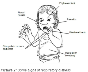 Signs of respiratory diestress