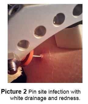 Pin-Site infectie