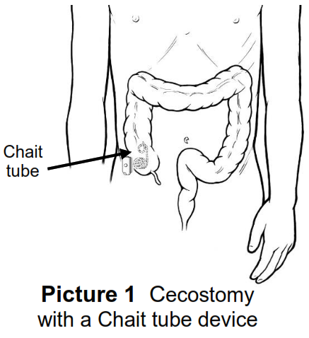 Line drawn picture of what a chait tube looks like inside the body