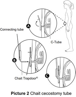 Line drawn picture of a zoomed in child's stomach with 3 other pictures beside it showing what the c-tube and chait trapdoor look like inside and outside the body