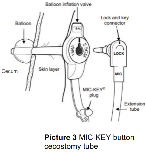 Line drawn picture of a MIC-KEY button cecostomy tube