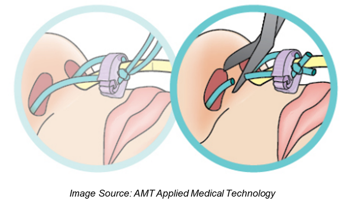 Graphic showing the removal of a nasal bridle. Scissors are used to cut the string on the side of the nose with only one blue string, not connected to the feeding tube.