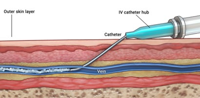 Diagram showing a peripheral intravenous (PIV) catheter inserted through the skin into a vein.