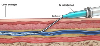 Normal: Comparison diagram showing a normal PIV catheter in a vein.