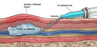 Extravasation: Diagram showing IV fluid or medicine leaking into surrounding tissue and causing swelling.