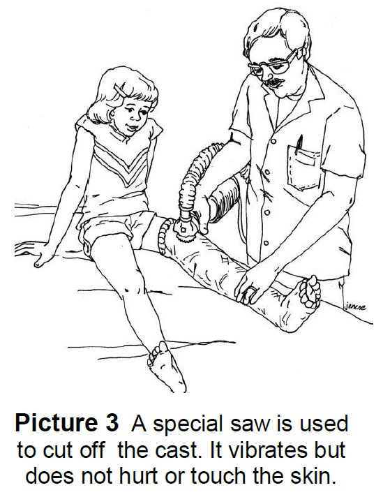 Cast being taken off using saw