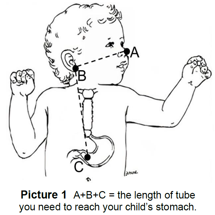 How to measure length of NG tube