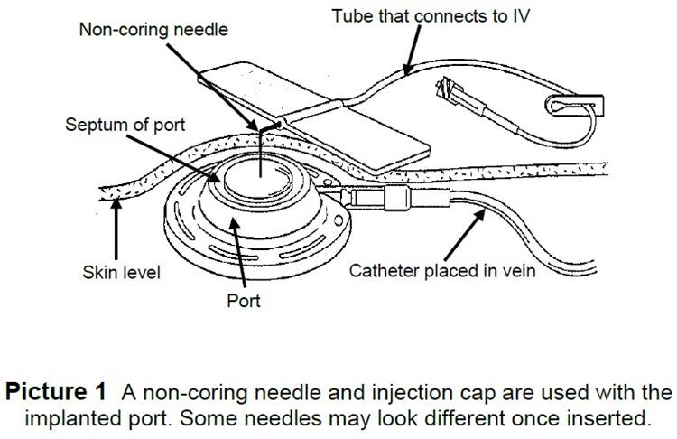 implanted port