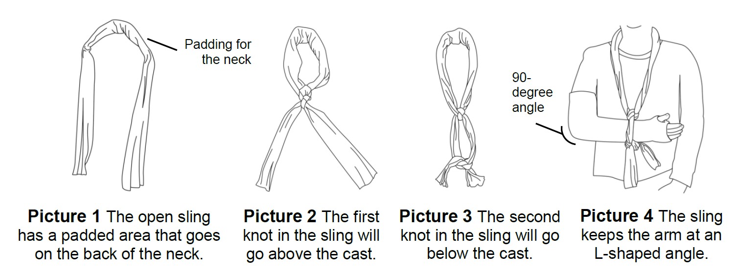 Collar and cuff sling on broken arm