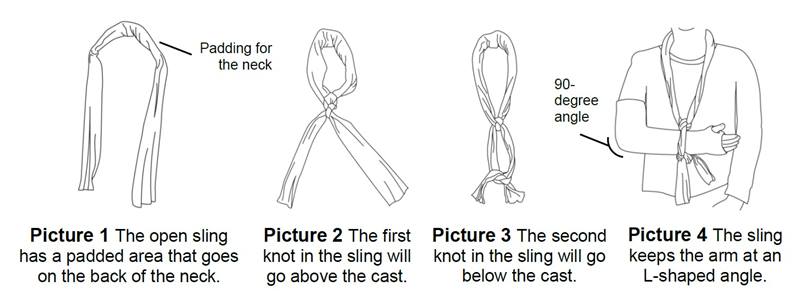 Collar and cuff sling on broken arm