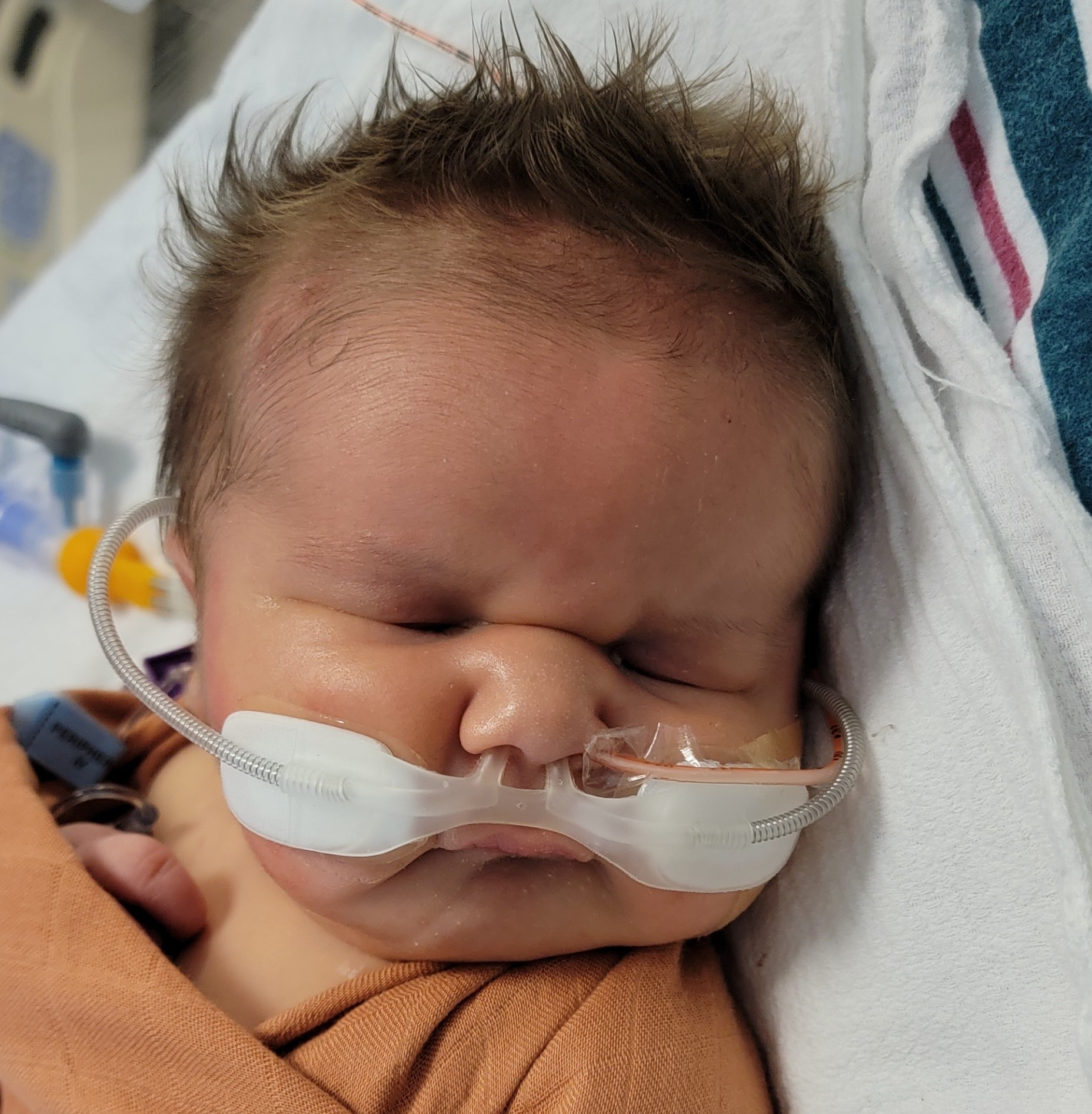 baby with oxygen tubes