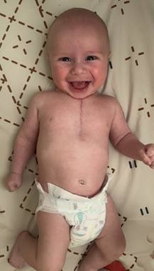 A happy baby lies on a patterned sheet wearing only a diaper, smiling brightly and showing a healing chest surgery scar.
