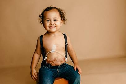 patient with colorectal scar