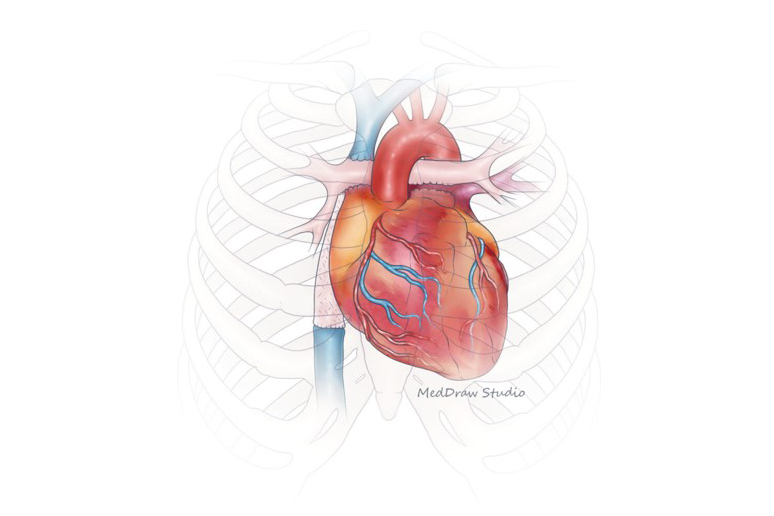 Medical illustration of a tissue engineered vascular graft (TEVG)