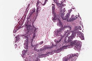 Tissue sample from cancer patient