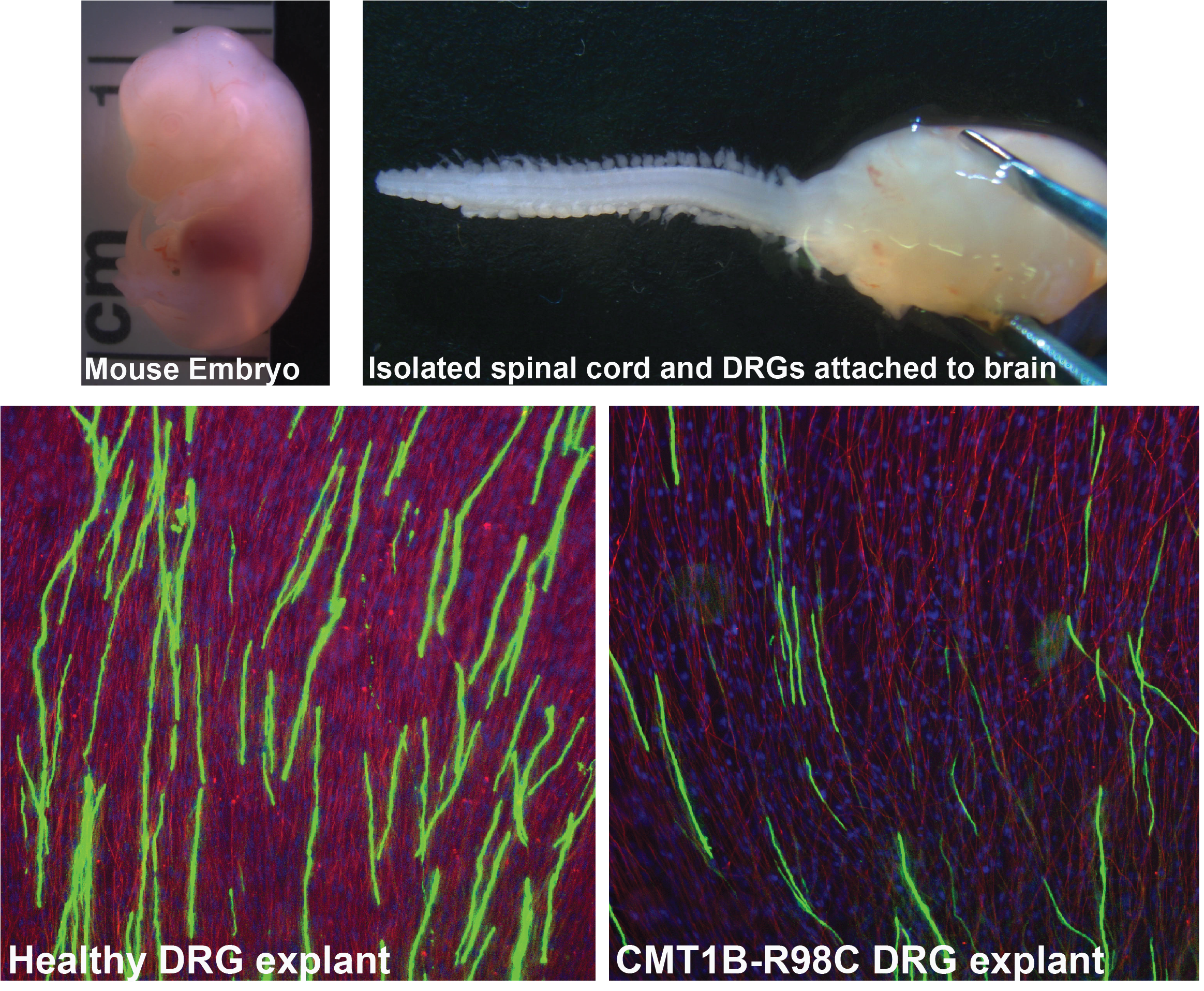 Developing gene therapy for Charcot-Marie-Tooth type 1B (CMT1B)