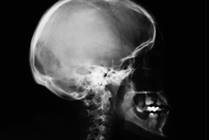 Sports-Related Concussion