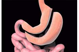 Gastric Sleeve Surgery