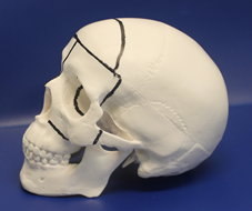 Box Osteotomy