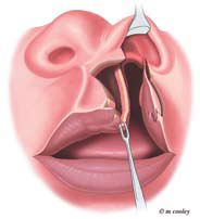 Cleft Lip Surgery