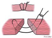 Cleft Lip Surgery